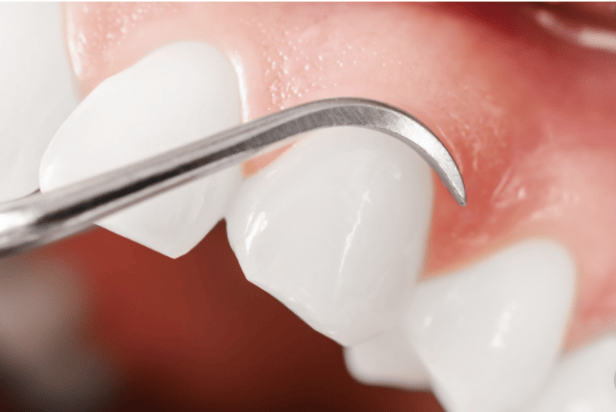Close up of a tooth with a scaler tool for PERIODONTISTS cover for prodent search